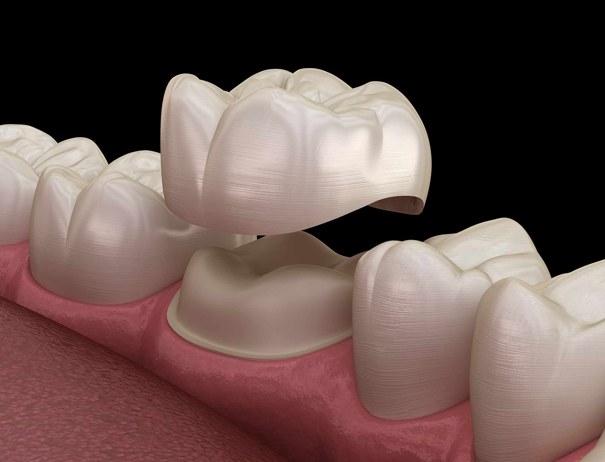 Tooth preparations for optimal success