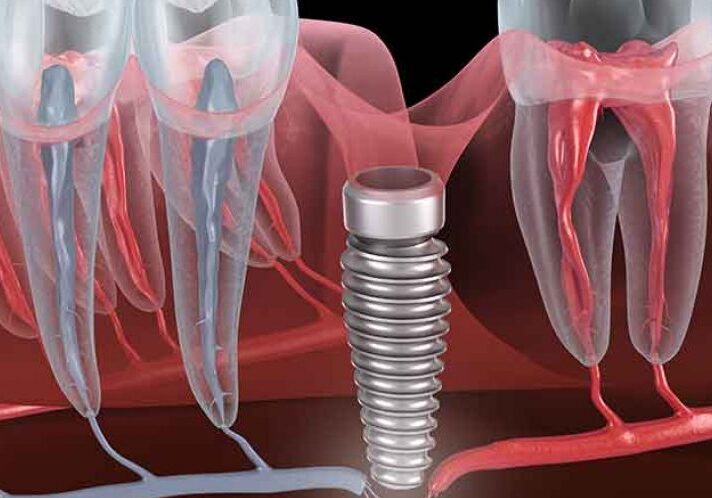 <strong>Clinical complications with implants and implant prostheses</strong>